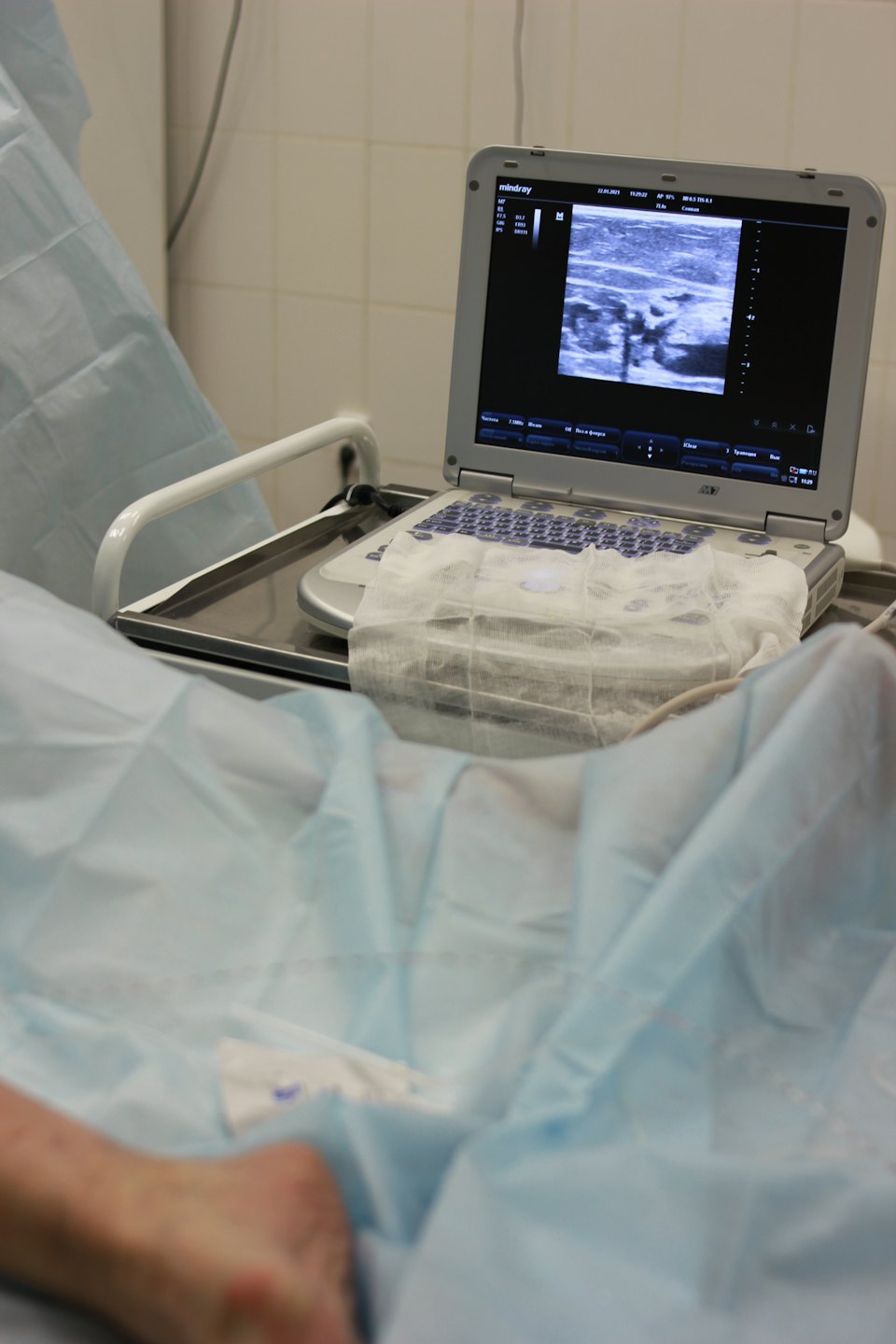 Ultrasound machine with transducer on keyboard near patient leg.